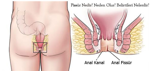 Anal Fiss R Nedir Anal Fiss R Tan M Belirtileri Te His Ve Tedavisi