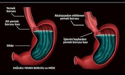 Akalazya Nedir? Akalazya Tanımı, Belirtileri, Nedenleri ve Tedavisi