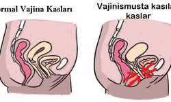 Vajinismus ilaçla tedavi edilir mi?